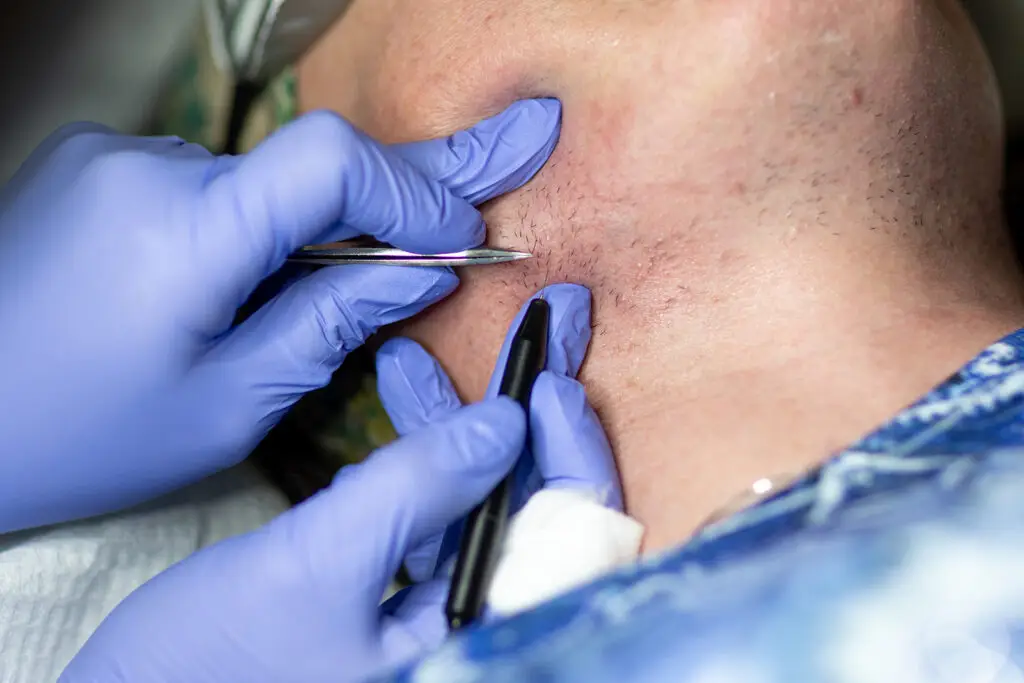 Showing Hair Electrolysis for me, only FDA approved method for permanent hair removal 