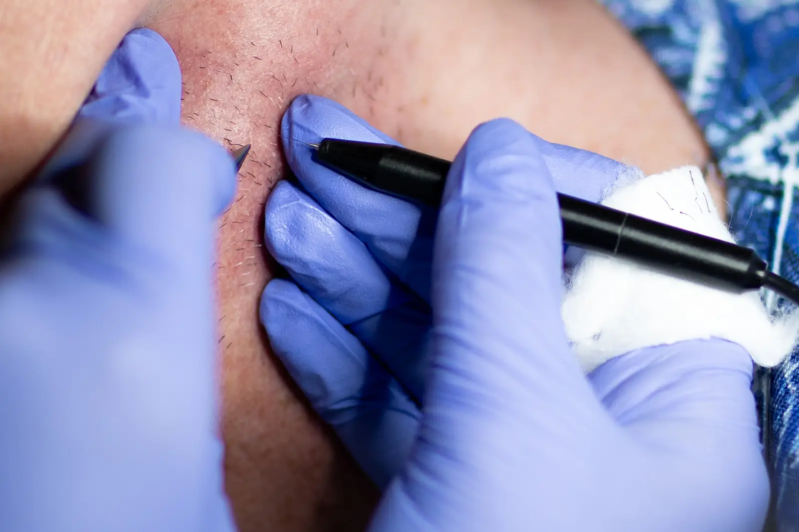 Ober Yahr Electrolysis will help sensitive areas on your body.