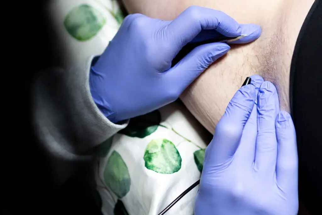 Ober Yahr Electrolysis perform hair electrolysis on patient