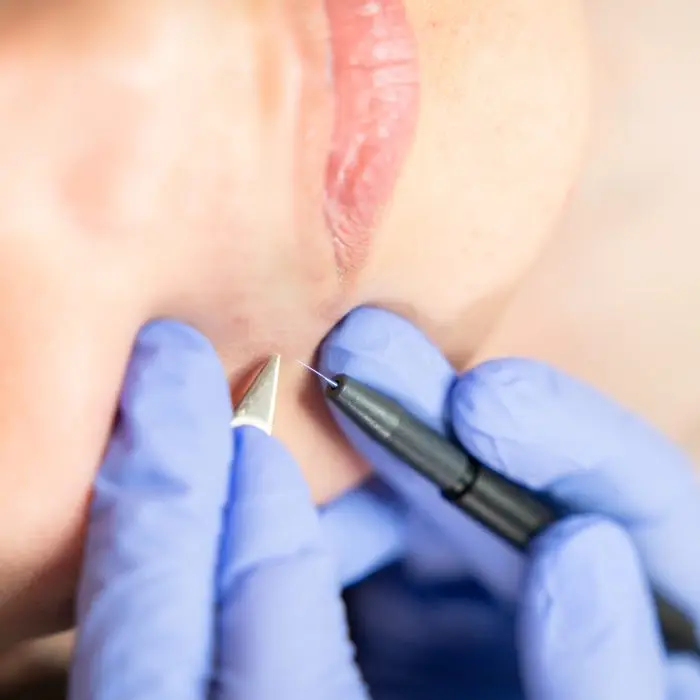Treatment at Ober Yahr Electrolysis