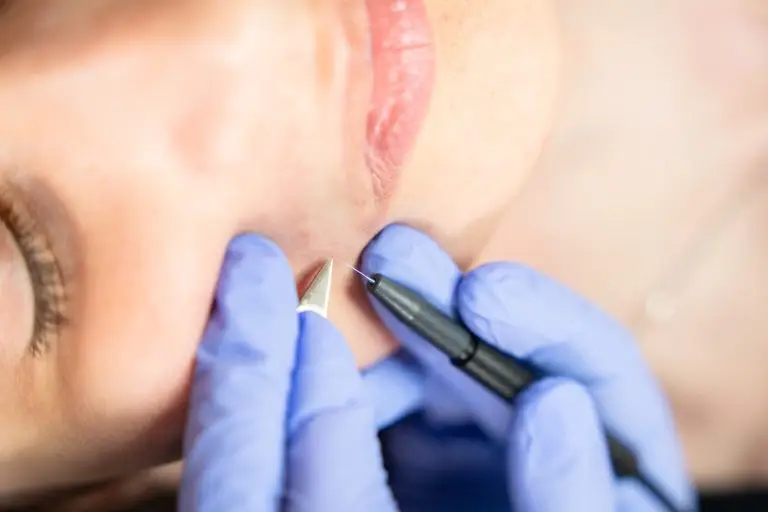 Treatment at Ober Yahr Electrolysis