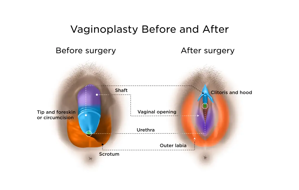 Vaginoplasty diagram