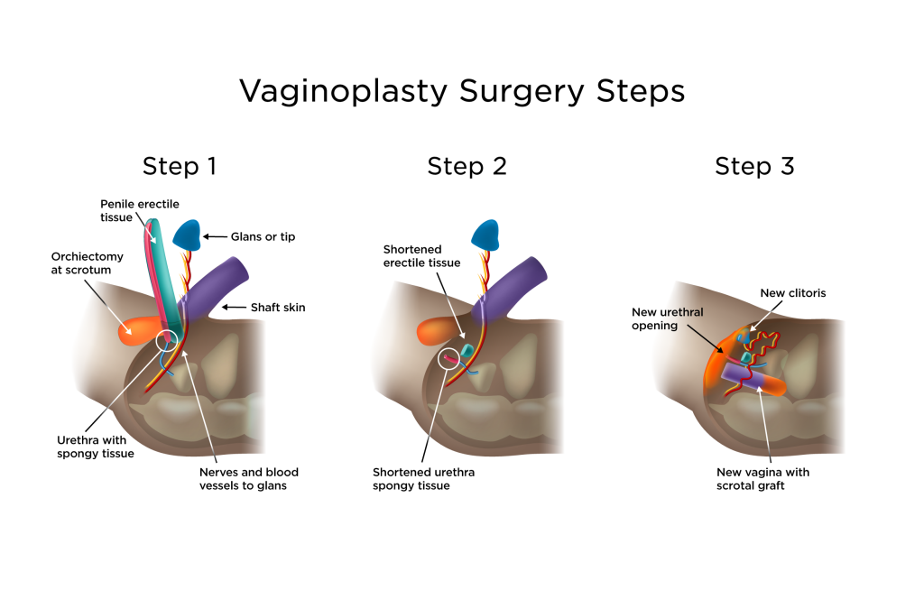 Vaginoplasty Steps 